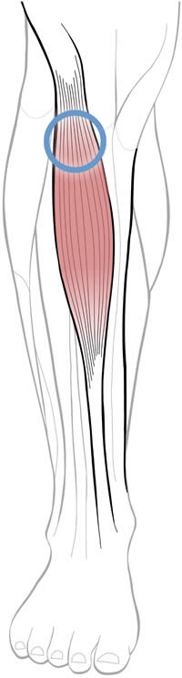 Diagram of tibialis anterior anatomy, showing the location of a significant myofascial trigger point (muscle knot), an under-diagnosed and under-treated factor in many cases of shin pain.