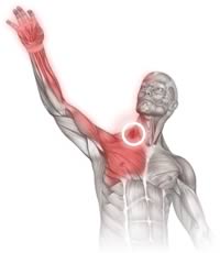 Diagram showing areas of pain referred from the scalene muscle group. This diagram shows the possible involvement of scalenes in chest pain, upper back pain, jaw pain, face pain, headache, arm pain and hand pain.