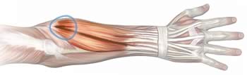 Anatomical illustration of the muscles on the back of the forearm, showing the location of a common trigger point in the common extensor tendon, where the muscles converge on the lateral epicondyle of the elbow.