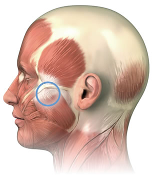 Diagram of jaw muscles, highlight the location of a common trigger point in the upper part of the masseter muscle.