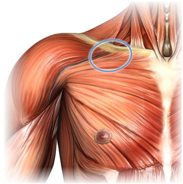 A diagram of pectoralis major anatomy, showing the best spot for massage right below the center of the collarbone.