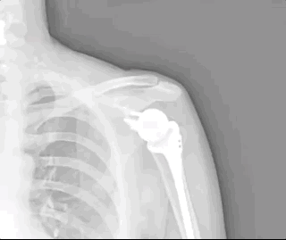Animated GIF showing how a frozen shoulder can still “fake” some range of motion.