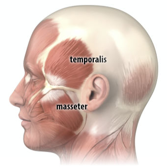 Anatomical drawing of the side of the head, labelling the temporalis muscle above the cheek bone and the masseter below.