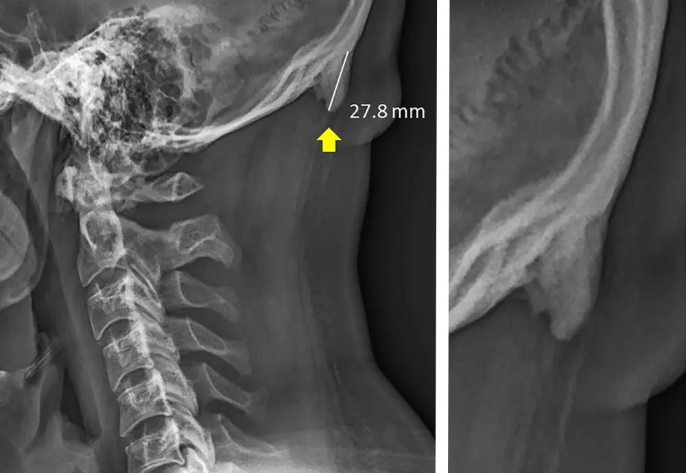 X-ray showing a bone spur on the back of a skull.