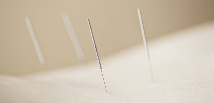 Close-up photograph of several acupuncture needles in someone’s back.
