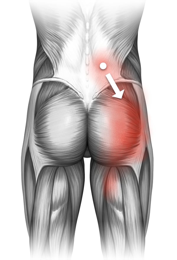 Diagram of trigger point referral, showing a spot in the middle of the right side lumbar paraspinals, radiating pain mainly into the buttock, but also a little into the upper hamstrings.