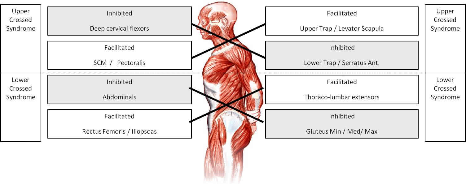Symptoms, Causes and Treatment of Bad Posture - Cronulla Physio Focus